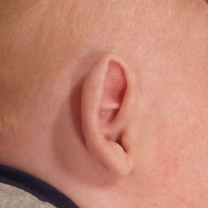 prominent ear deformity before treatment