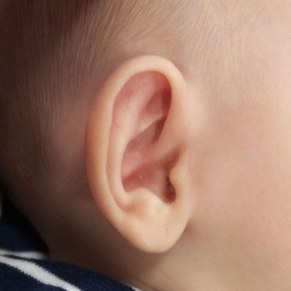 prominent ears in newborn before treatment