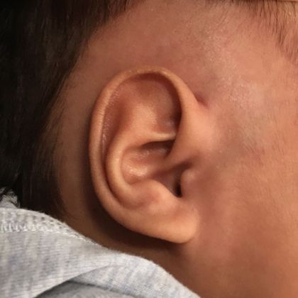 extra fold of ear cartilage after birth after treatment
