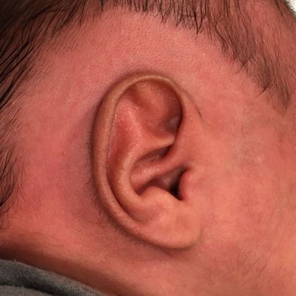 extra fold of ear cartilage after birth before treatment