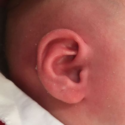 helical rim ear deformity after treatment