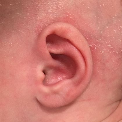 helical rim ear deformity before treatment