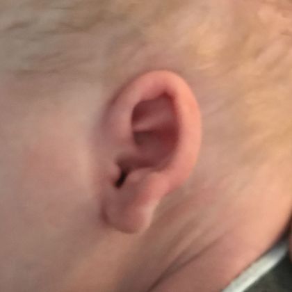 ear is prominent and sticks out before treatment