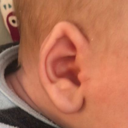helical rim ear deformitybefore treatment