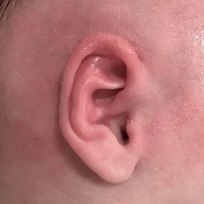 bent and folded ear cartilage after treatment
