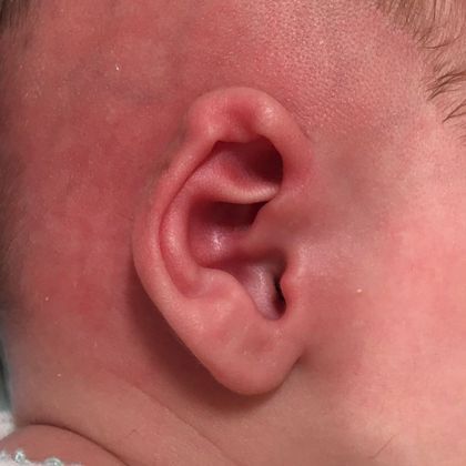 bent and folded ear cartilage before treatment