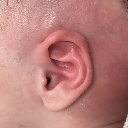 constricted and prominent ear deformity after treatment