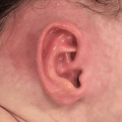 bent and pointed ear cartilage after treatment