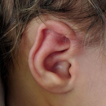 bent and pointed ear cartilage before treatment