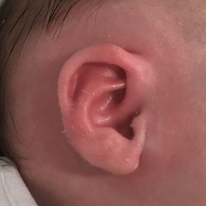 ear molding to reshape the baby’s ear after treatment