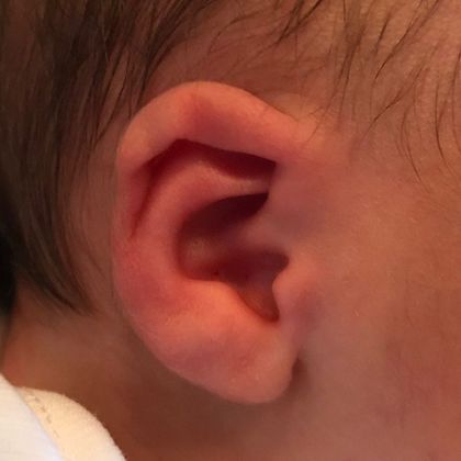 ear molding to reshape the baby’s ear before treatment