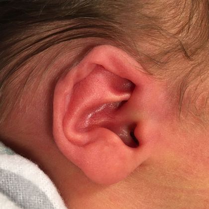 outer rim of the ear which was bent and wrinkled before treatment