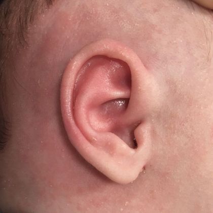 correction of a prominent ear after treatment
