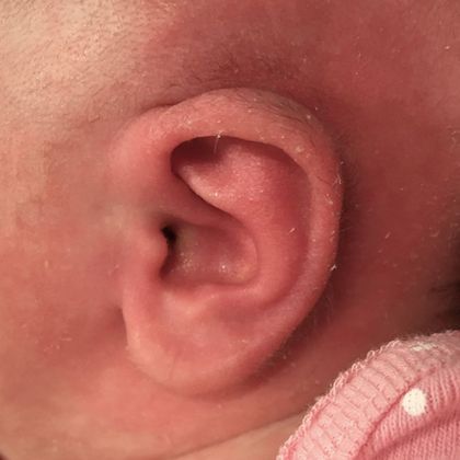 prominent ear with mild constriction after treatment