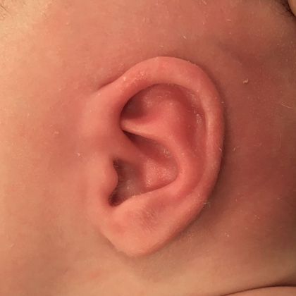 elf ear after treatment