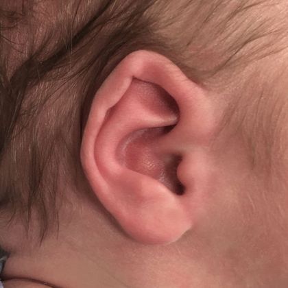 helical rim ear deformity before treatment