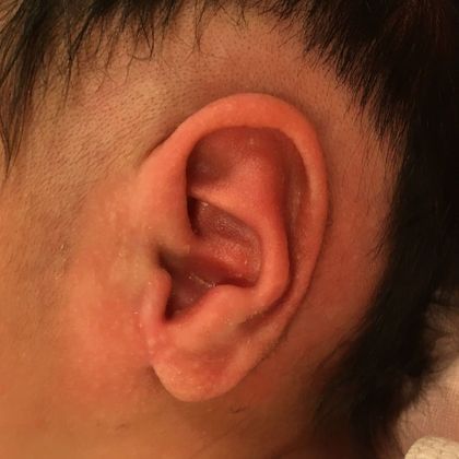 Stahl’s ear deformity after treatment