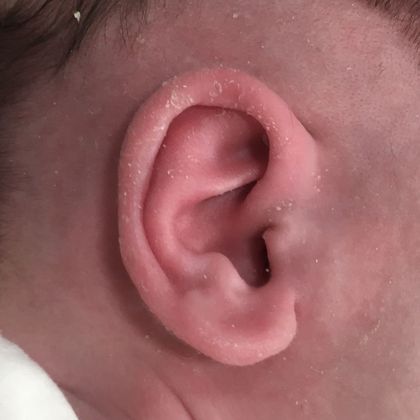 an ear that sticks after treatment