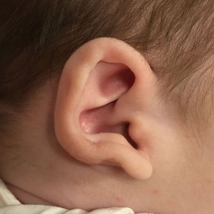 an ear that sticks before treatment
