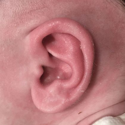 ear cartilage folded inward after treatment