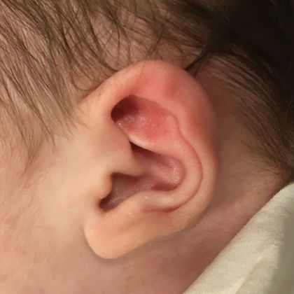 ear cartilage folded inward before treatment