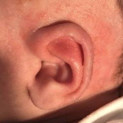 The baby ear was pointed and stuck out after treatment