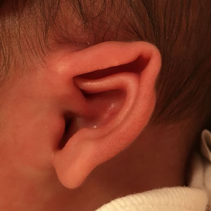 The baby ear was pointed and stuck out before treatment