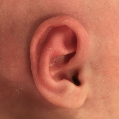 The abnormal baby ear shape after treatment
