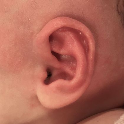 The abnormal baby ear shape after treatment