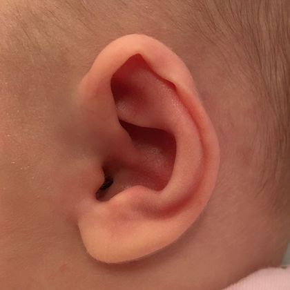 The abnormal baby ear shape before treatment