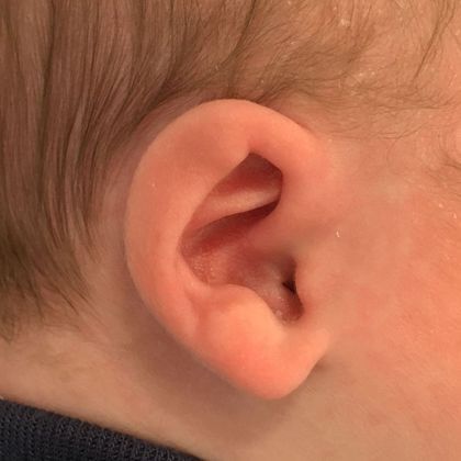 cup ear deformity before treatment