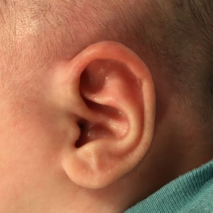 This ear lidding deformity after treatment