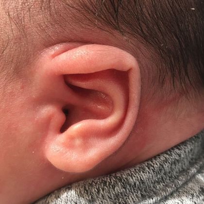 This ear lidding deformity before treatment