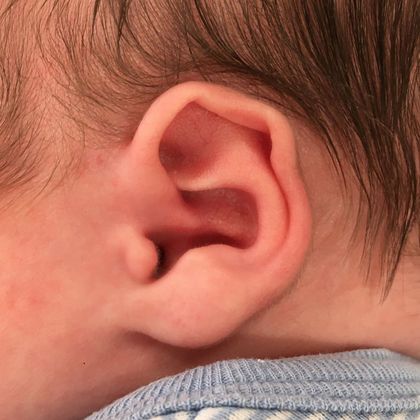 bent ear cartilage before treatment