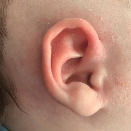 bent and warped ear cartilage after treatment