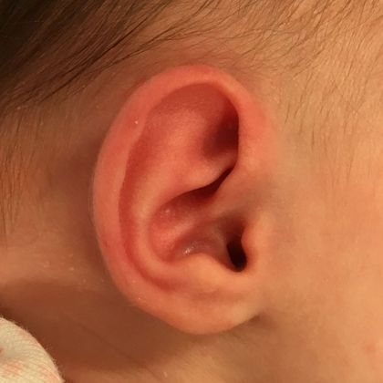 an ear that sticks out after treatment