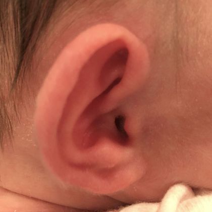 an ear that sticks out before treatment