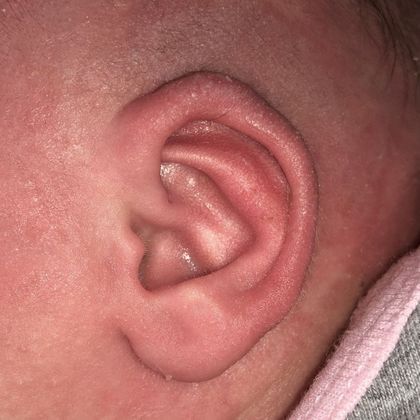 an ear that sticks out after treatment