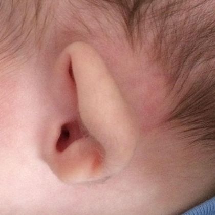 prominent ear deformity in Connecticut