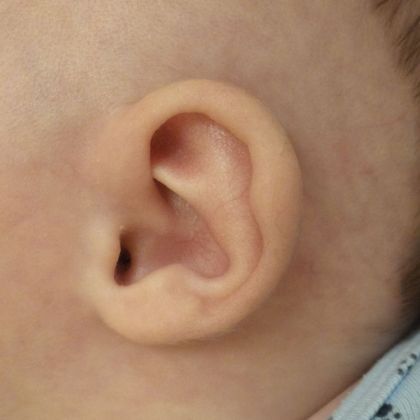 ear deformity in Connecticut corrected