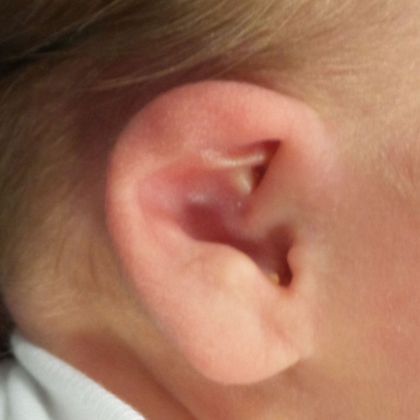 cup ear deformity