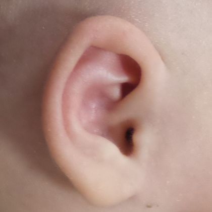 A cup ear deformity which was corrected