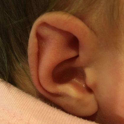 Stahl’s ear deformity Corrected