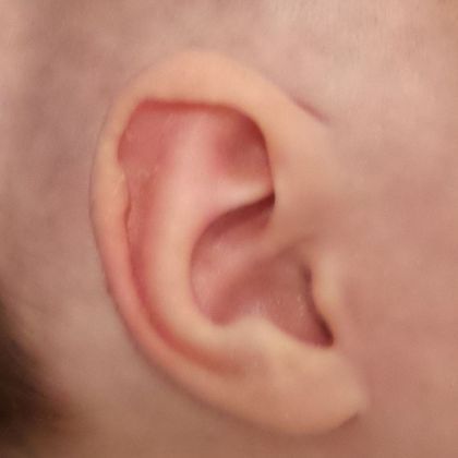 Stahl’s ear deformity