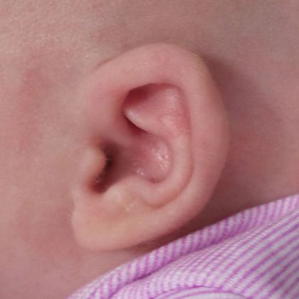 a cup ear deformity Corrected