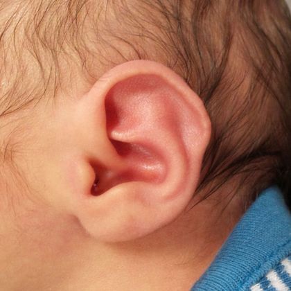 Helical rim ear deformity