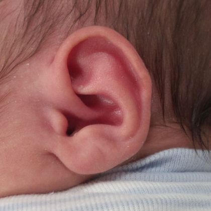 Helical rim ear deformity which was corrected