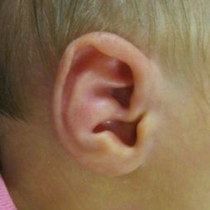 A conchal crus ear deformity