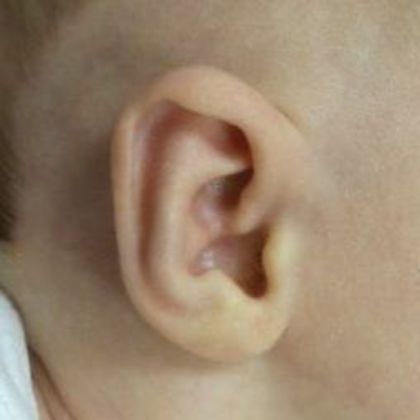 a conchal crus ear deformity fixed