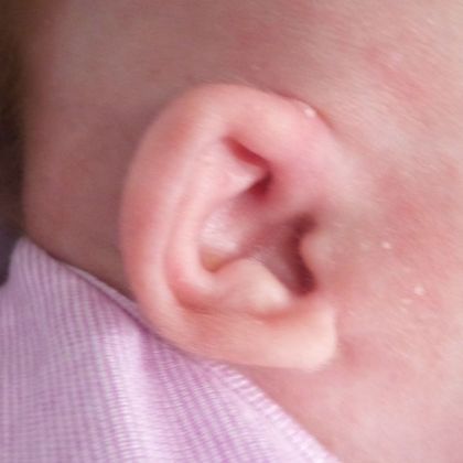 Ear that sticks out Fixed